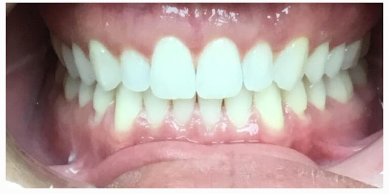 Orthodontics-After