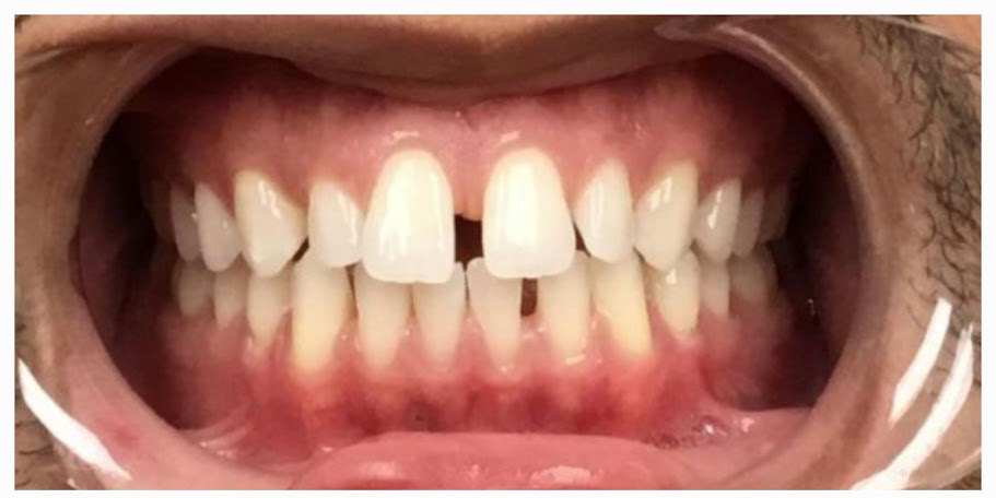 Orthodontics-Before