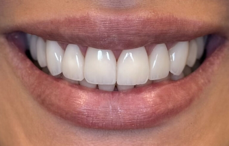 Smile Makeover - After