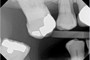 Dentist in Spotswood New Jersey discusses missing teeth