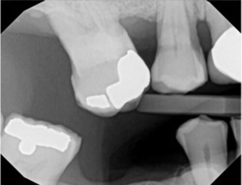 Your Dentist in Spotswood, New Jersey Provides Insights On Missing Teeth And Overall Health