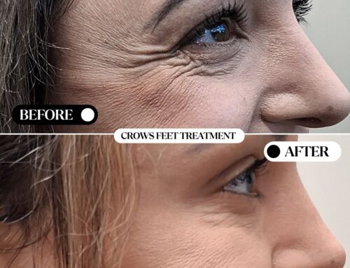 Therapeutic Botox in Dentistry