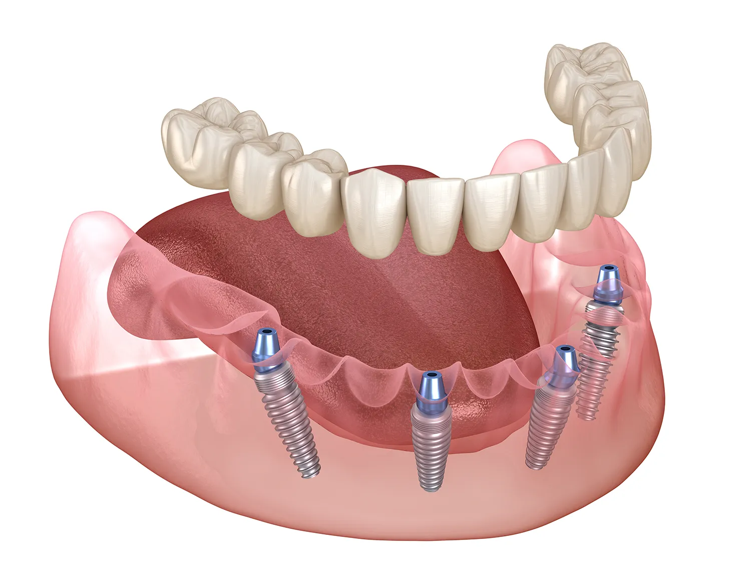 Implant dentures New Jersey - SiRa Dentistry