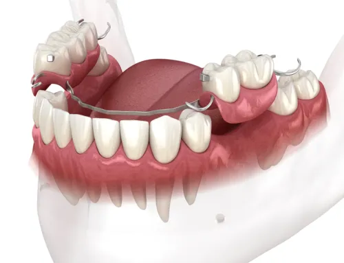 The Truth About Tooth Gaps: Why ‘Waiting to See’ Costs Monroe Township Patients Dearly.