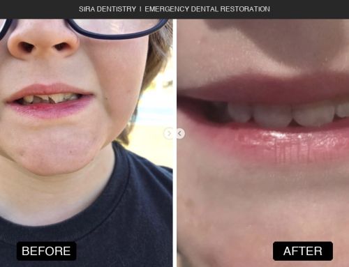 When a Child Breaks Both Front Teeth on the Playground, Every Minute Counts